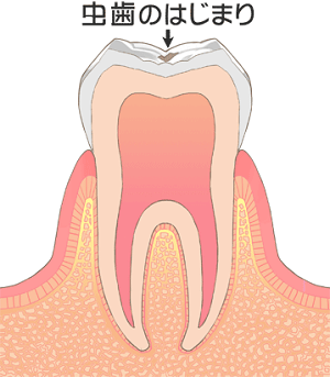 初期の虫歯は放置しても大丈夫！？