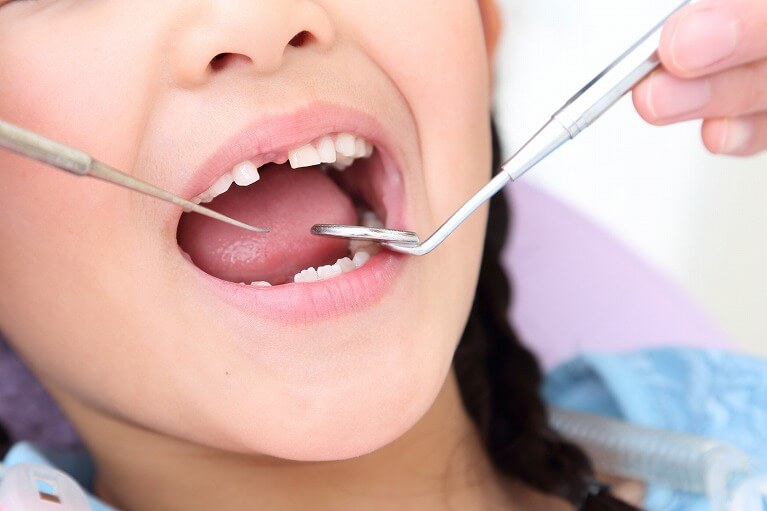 矯正治療が必要な子供の歯並び