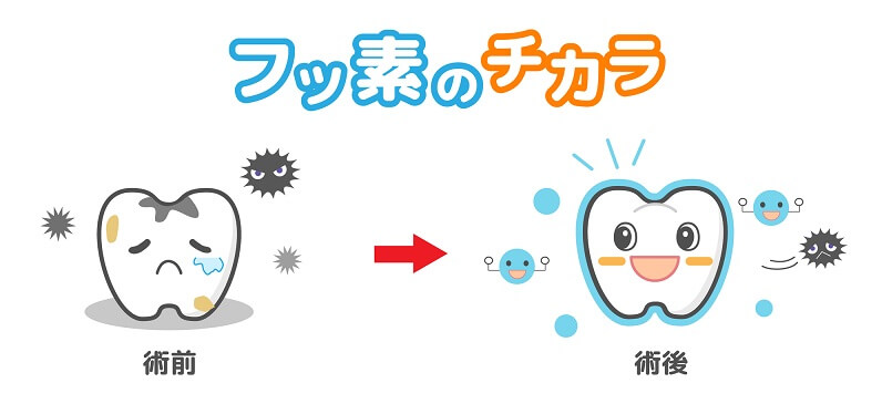 フッ素塗布の頻度・料金は？効果は？｜おひさま歯科・こども歯科｜知多市