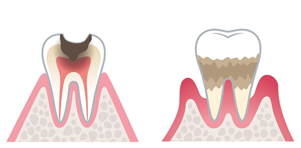 虫歯や歯周病