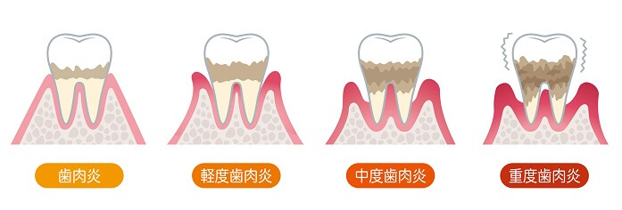 歯周病は自然に治る？放置するとどうなる？