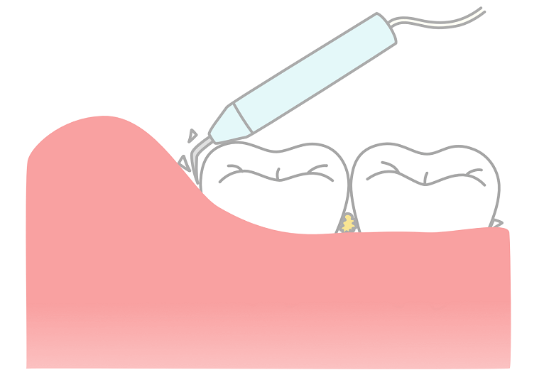 歯石取り(歯石除去)の頻度