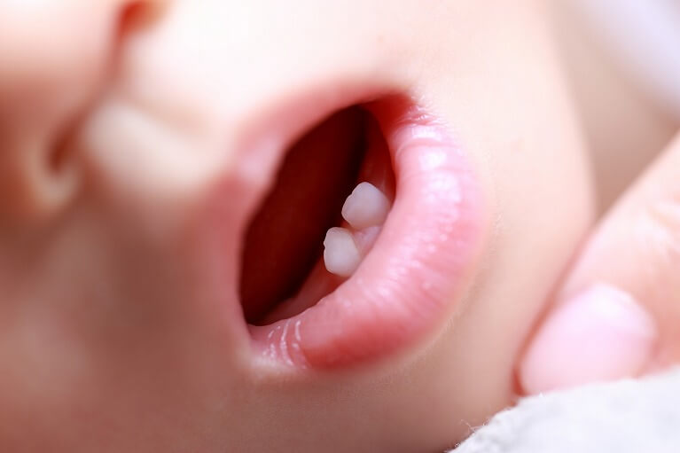 乳歯は一気に虫歯が進行する！？