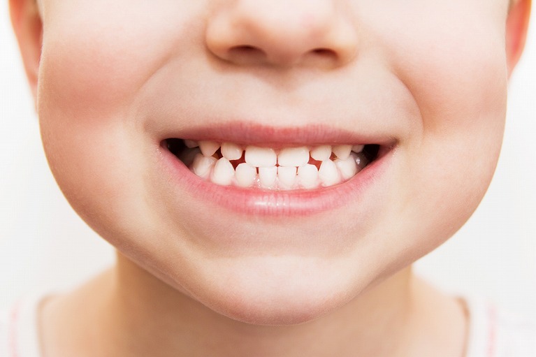 子供の受け口の治し方‐原因や予防｜愛知県知多市おひさま歯科・こども歯科