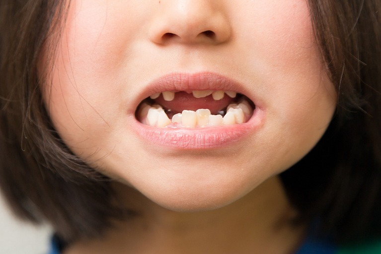 歯並びがガタガタ…悪い歯並びの原因