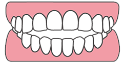 奥歯を嚙んでも前歯が閉じない（開咬）