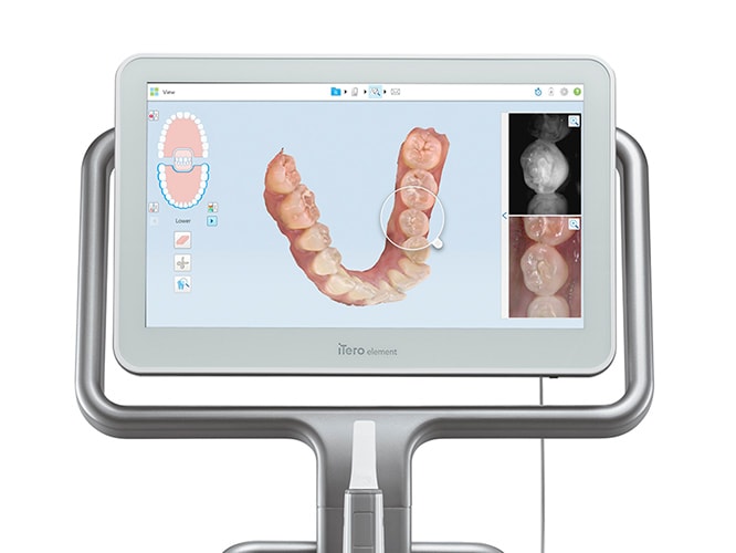 iTero導入でストレスフリーな検査