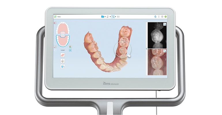 iTero導入でストレスフリーな検査
